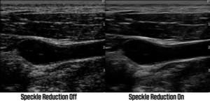 Speckle Reduction ultrasound